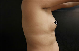 Breast Augmentation