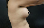 Breast Augmentation