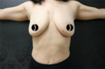 Breast Augmentation