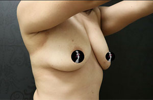 Breast Augmentation