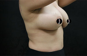 Breast Augmentation