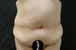 Tummy Tuck