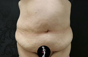 Tummy Tuck