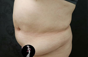 Tummy Tuck