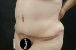 Tummy Tuck