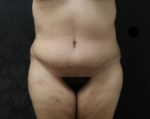 Tummy Tuck