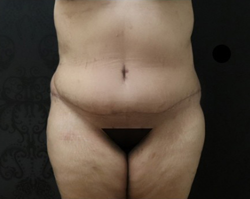 Tummy Tuck