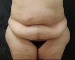 Liposuction