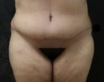 Liposuction