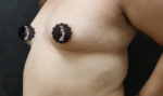 Breast Augmentation