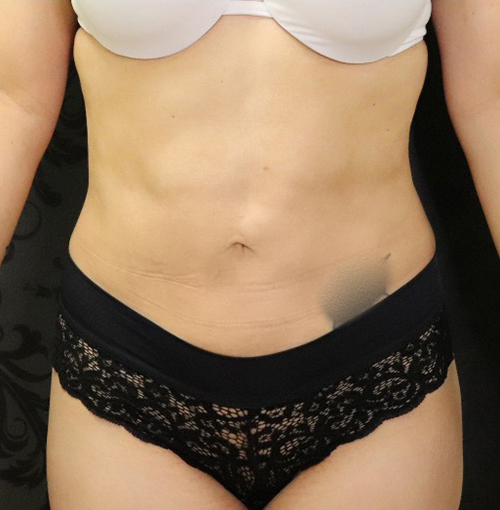 Liposuction