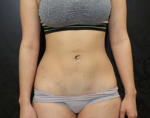 Liposuction