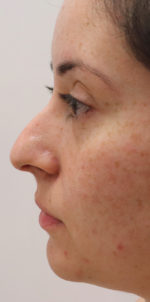 Non-Surgical Rhinoplasty