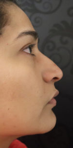 Non-Surgical Rhinoplasty