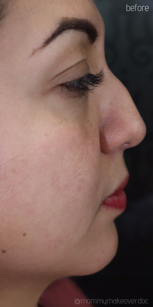 Non-Surgical Rhinoplasty