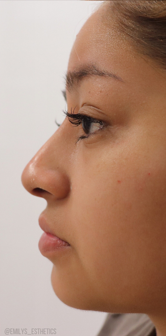 Non-Surgical Rhinoplasty