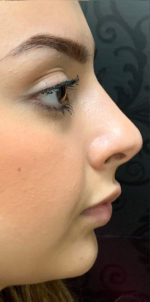 Non-Surgical Rhinoplasty