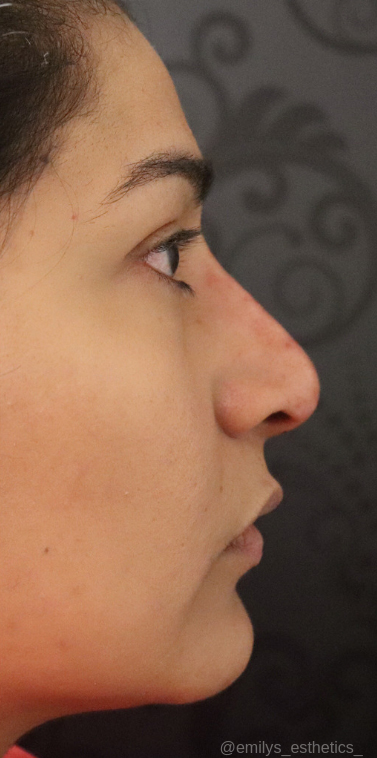 Non-Surgical Rhinoplasty