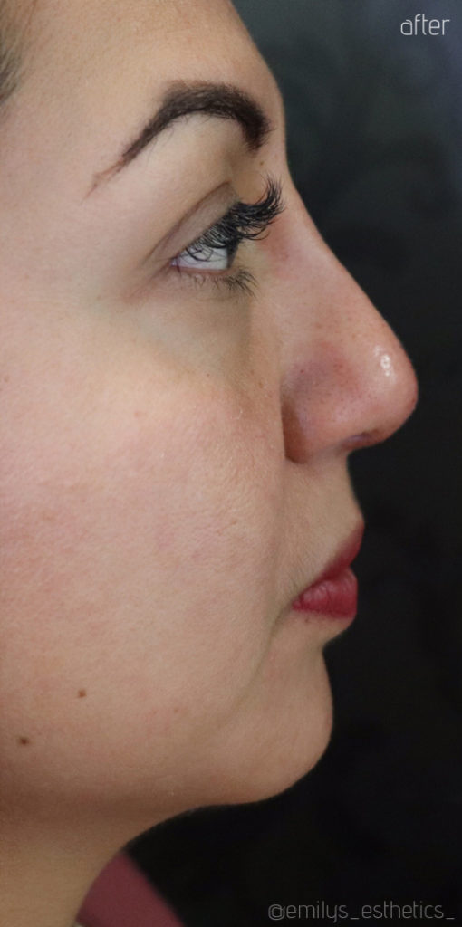 Non-Surgical Rhinoplasty