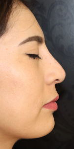 Non-Surgical Rhinoplasty