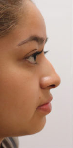 Non-Surgical Rhinoplasty