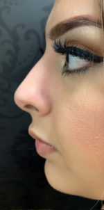 Non-Surgical Rhinoplasty