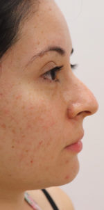 Non-Surgical Rhinoplasty