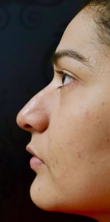 Non-Surgical Rhinoplasty