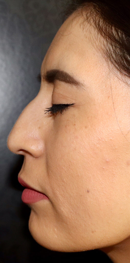 Non-Surgical Rhinoplasty