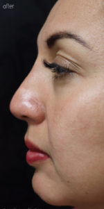 Non-Surgical Rhinoplasty