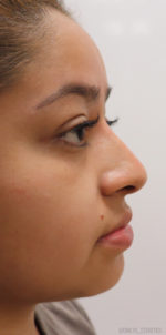 Non-Surgical Rhinoplasty