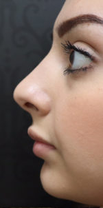 Non-Surgical Rhinoplasty