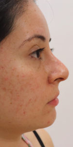 Non-Surgical Rhinoplasty