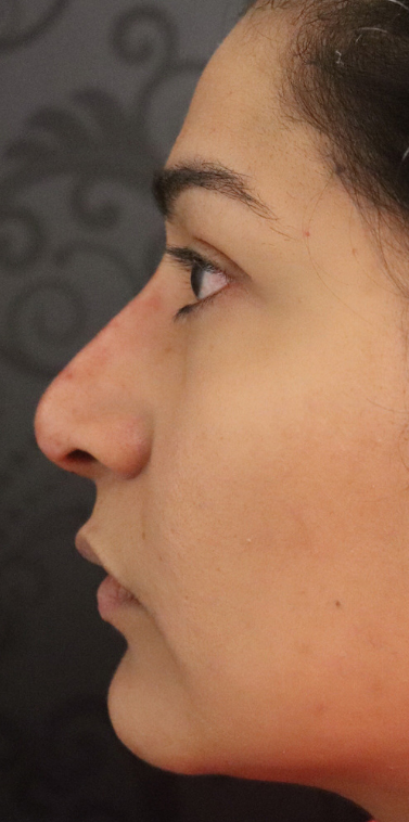 Non-Surgical Rhinoplasty