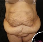 Liposuction