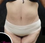 Liposuction