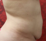 Tummy Tuck