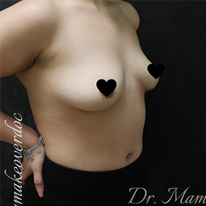 Breast Augmentation