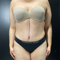 Liposuction