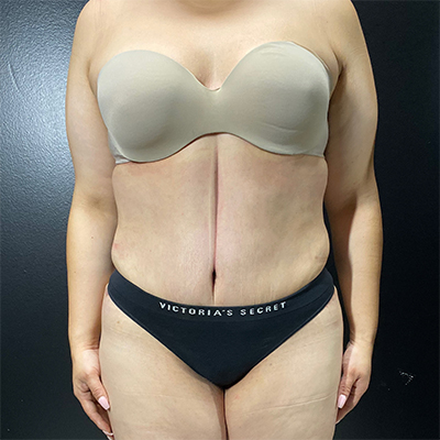 Liposuction