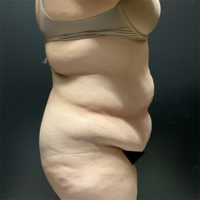 Liposuction