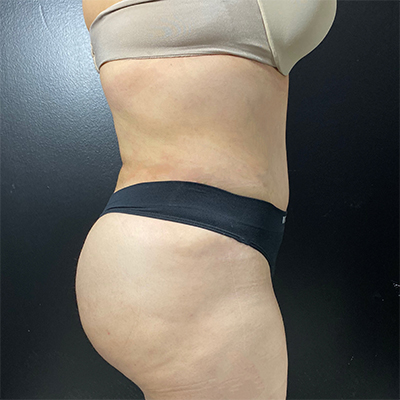 Liposuction