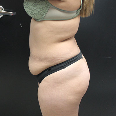 Mini Tummy Tuck