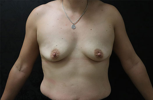 Breast Augmentation