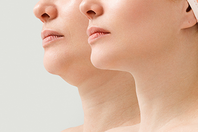 Aged woman before and after the facelift procedure