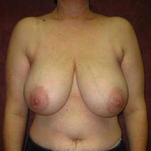 breast lift without surgery