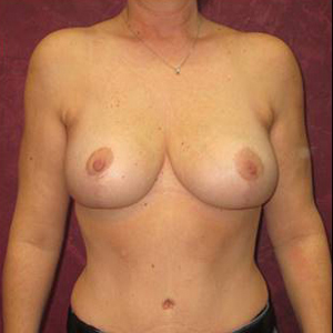 breast lift Before & After