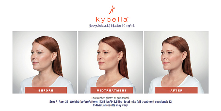 Kybella Antes y después de