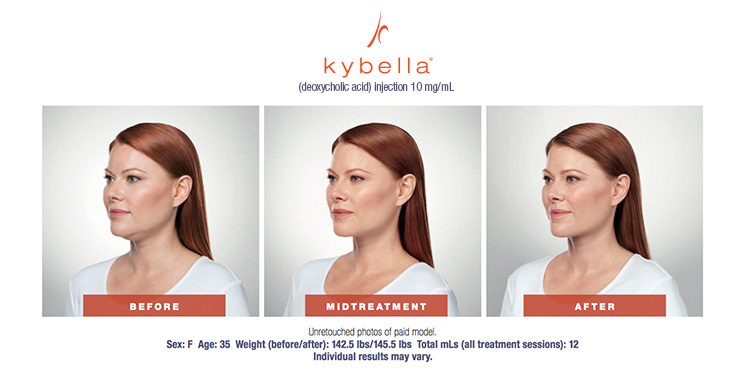 Kybella Before & After