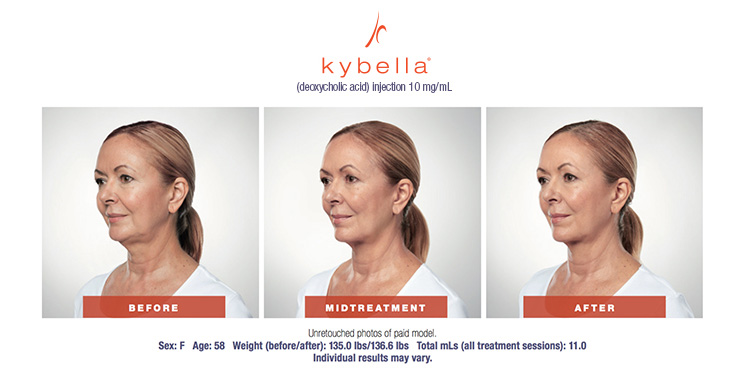 Kybella Antes y después de